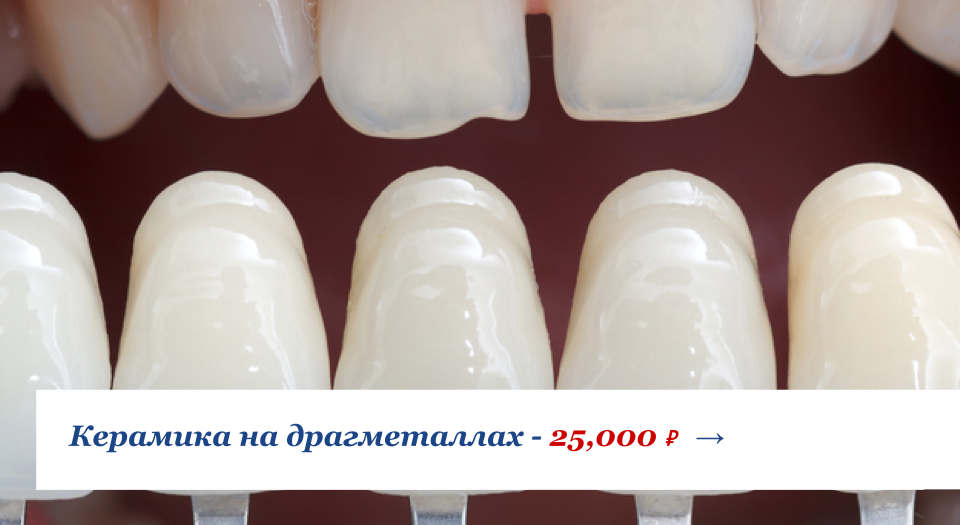 Керамика на драгметаллах от 25,000 рублей